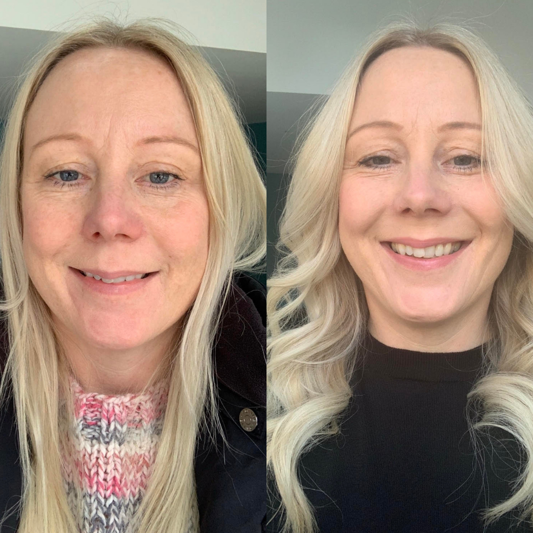 Collagen before and after picture