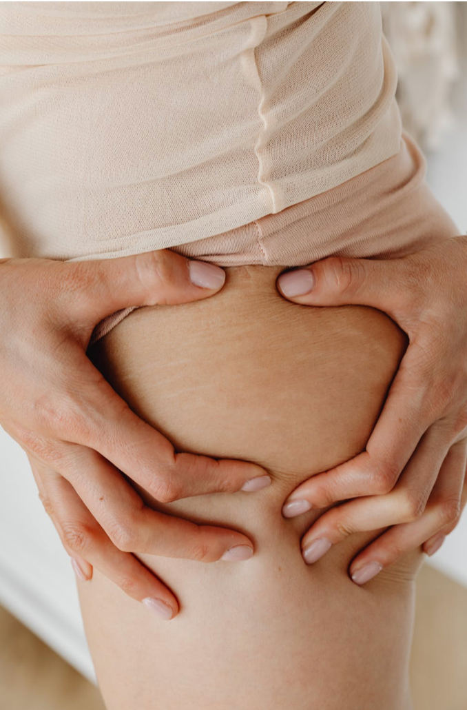 Stretch marks - can collagen help?